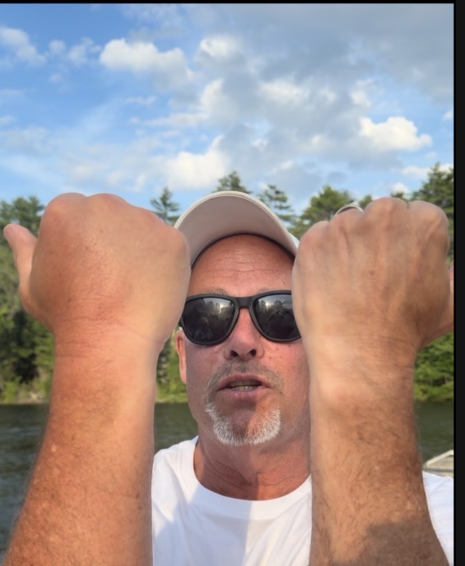 Swollen hand from a bee sting on Sebago Lake